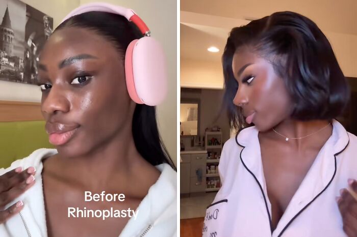 Side-by-side before and after photos of a woman showing results of plastic surgery rhinoplasty transformation.