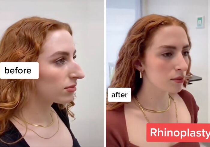 Side-by-side before and after photos of a woman showing rhinoplasty results from plastic surgery transformation.