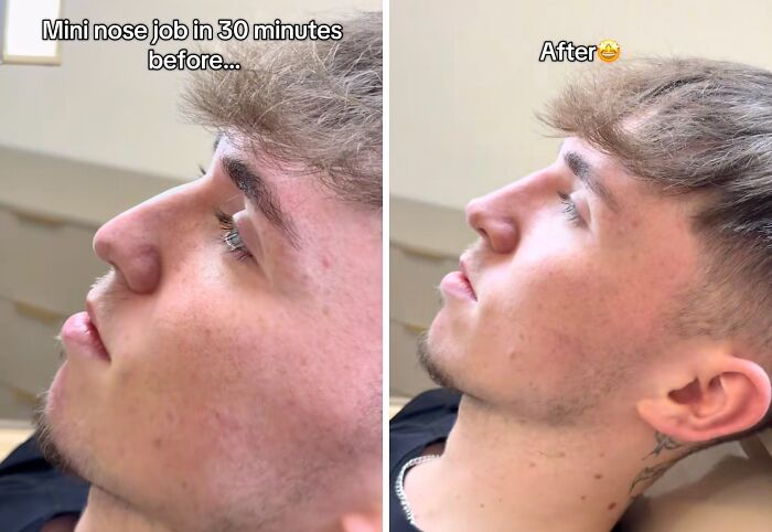 Side-by-side before and after photos showing plastic surgery results of a mini nose job transformation.