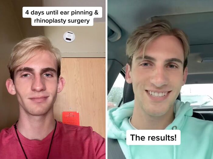Young man showing before and after plastic surgery results with ear pinning and rhinoplasty transformation.