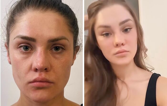 Side-by-side before and after photos of a woman showcasing changes from plastic surgery results shared online.