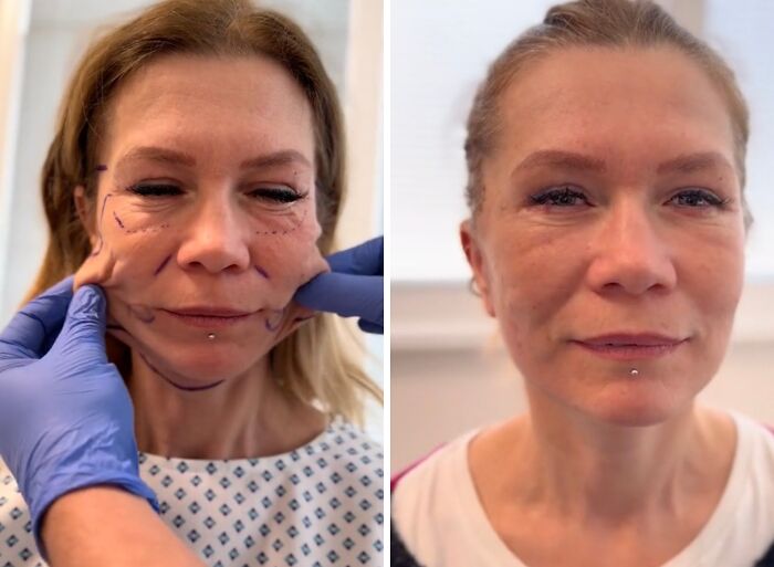 Before and after photos of a woman showing results of plastic surgery for facial contouring and wrinkle reduction.