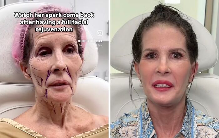 Elderly woman with facial markings preparing for plastic surgery as part of a facial rejuvenation transformation.