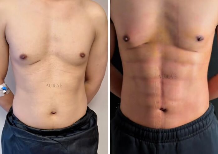 Shirtless person showing midsection and chest, illustrating plastic surgery transformation results online.