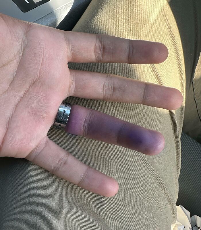 Hand with a swollen purple finger stuck in a ring, showing lack of common sense and survival mishap.