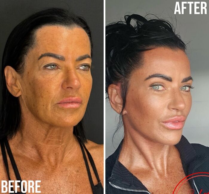 Before and after comparison of a woman who became unrecognizable after cosmetic surgery in Turkey, highlighting facial transformation.