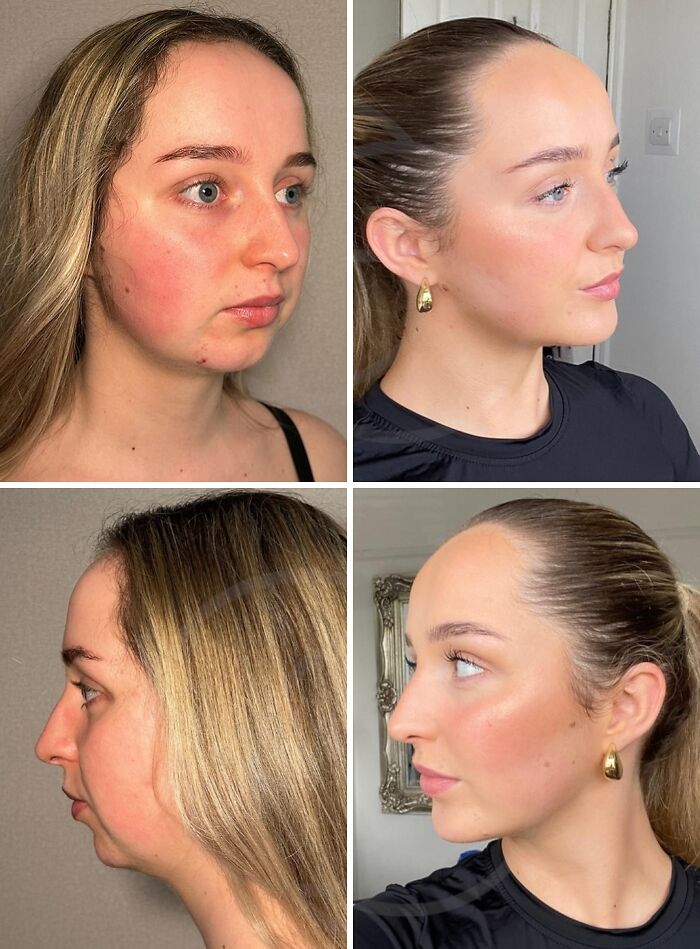 Before and after photos showing dramatic cosmetic surgery transformation in Turkey with improved facial features and contour.