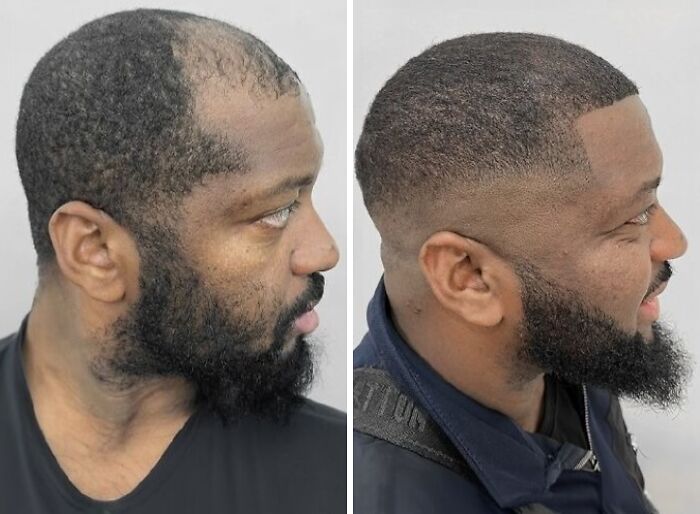 Before and after images showing a man’s hair transformation after cosmetic surgery in Turkey, highlighting dramatic changes.