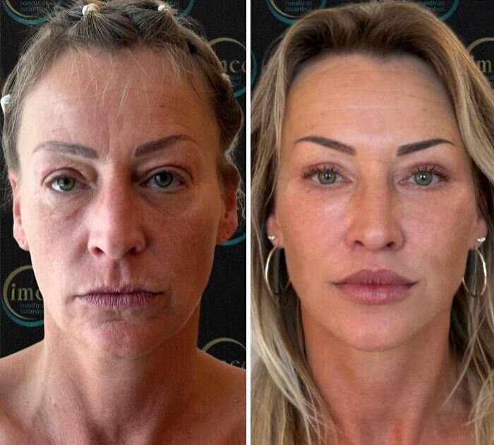 Before and after cosmetic surgery in Turkey showing dramatic facial transformation of a middle-aged woman.