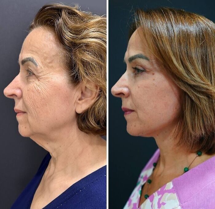 Before and after images of a woman showing dramatic changes after cosmetic surgery in Turkey with smoother skin and refined facial features.