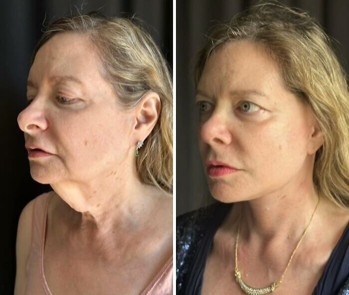 Side-by-side before and after photos of a woman showing results of cosmetic surgery in Turkey.