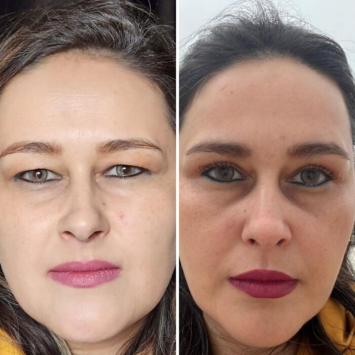 Before and after close-up portraits of a woman showing changes from cosmetic surgery in Turkey altering her facial features.