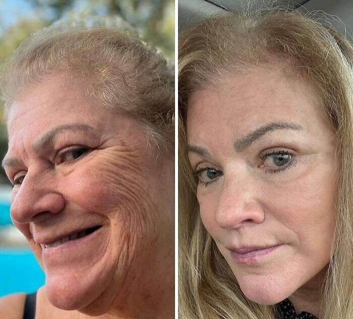 Before and after close-up portraits of a woman showing dramatic changes after cosmetic surgery in Turkey.