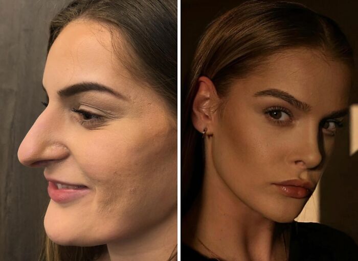 Side-by-side close-up of a woman before and after cosmetic surgery in Turkey showing dramatic facial transformation.