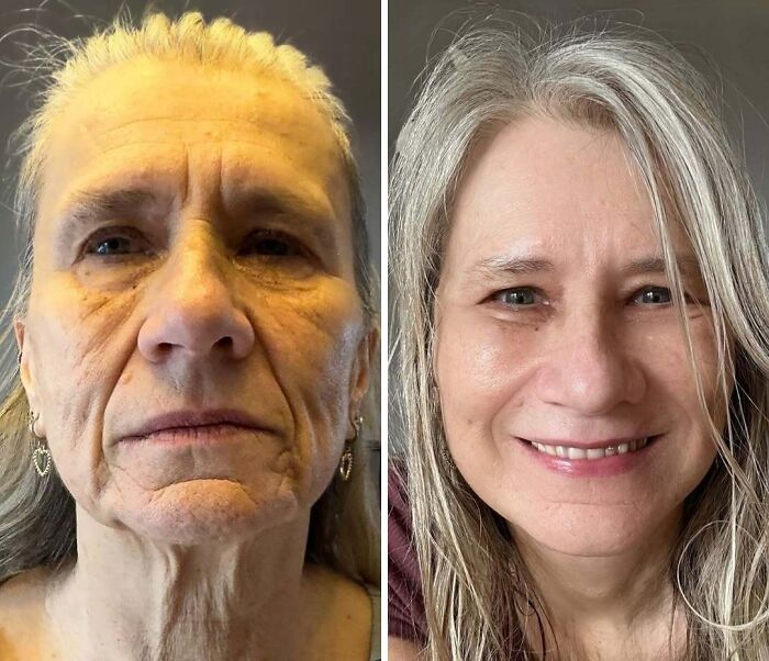 Before and after photos showing dramatic cosmetic surgery transformation in Turkey with significant facial rejuvenation results.