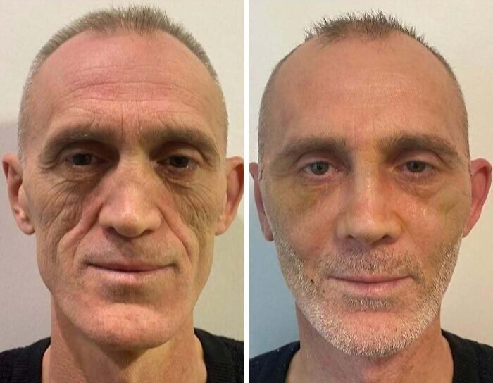 Side-by-side photos of a man showing changes after cosmetic surgery in Turkey, highlighting unrecognizable transformation.