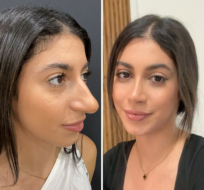 Side by side before and after photos showing a woman’s cosmetic surgery transformation in Turkey with a refined nose and softer features.