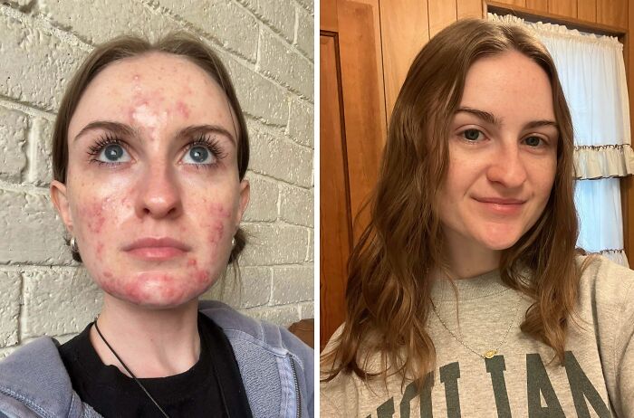 Before and after photos of a woman who turned her skincare dream into reality, inspiring the internet with her clear skin transformation.