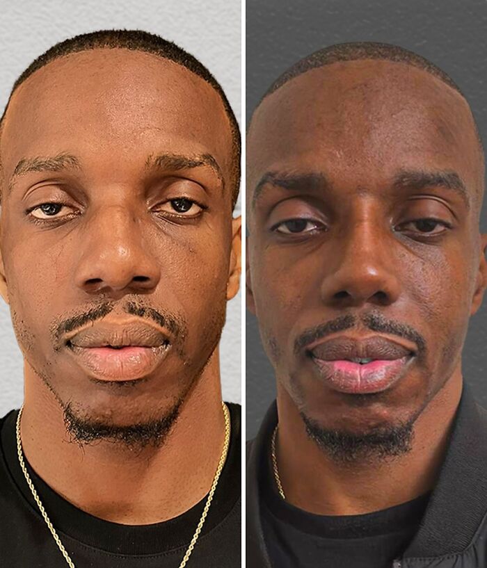 Before and after photos of a man showing changes from cosmetic surgery in Turkey, highlighting unrecognizable transformation.