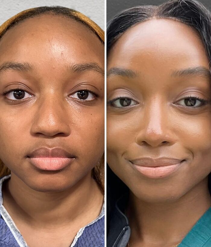 Before and after close-up of a woman’s face showing dramatic cosmetic surgery results in Turkey, highlighting transformation.