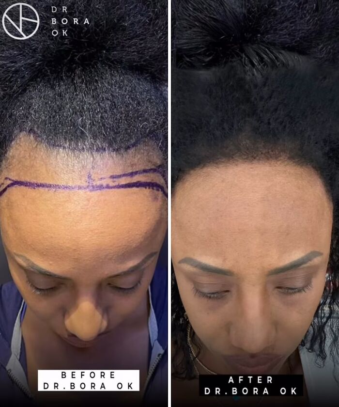 Before and after images showing hairline restoration results of cosmetic surgery in Turkey by Dr Bora Ok.