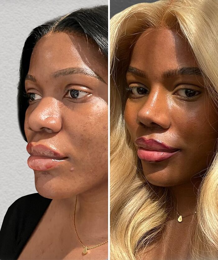 Before and after close-up of a woman showing changes after cosmetic surgery in Turkey with noticeable facial enhancements.