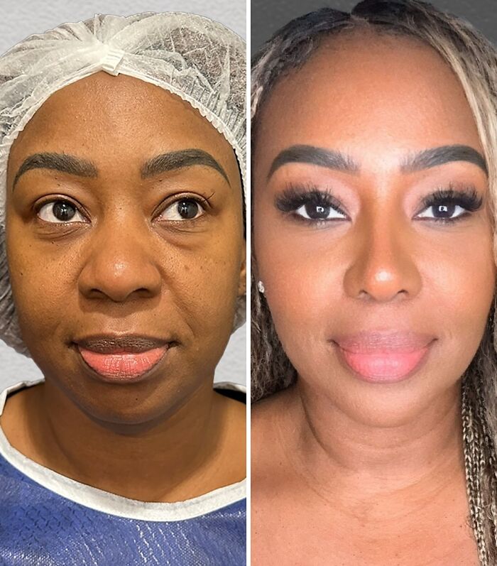 Side-by-side before and after images showing a woman’s transformation after cosmetic surgery in Turkey.