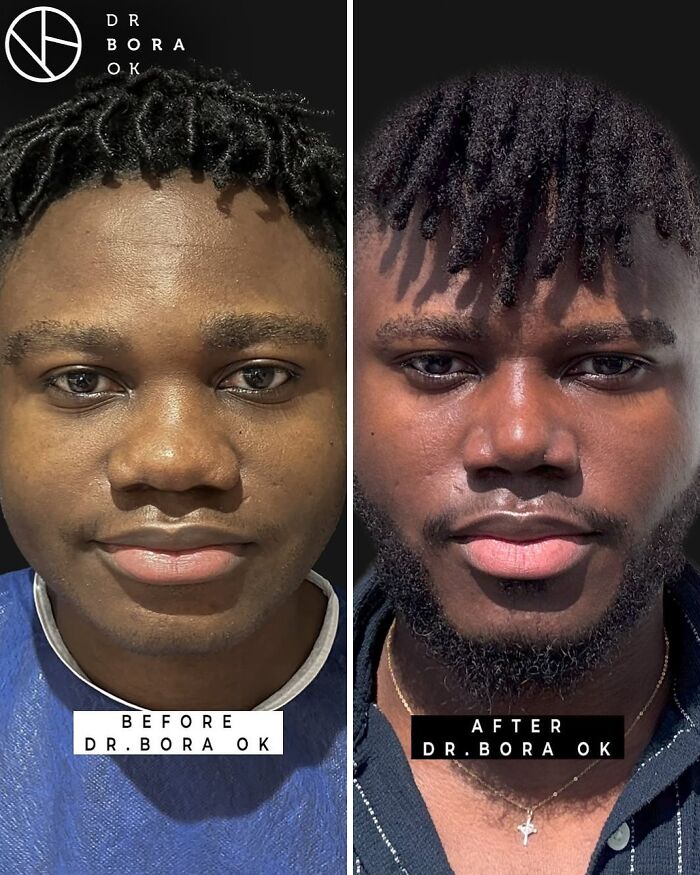 Before and after cosmetic surgery in Turkey showing dramatic transformation by Dr. Bora Ok on a young man.