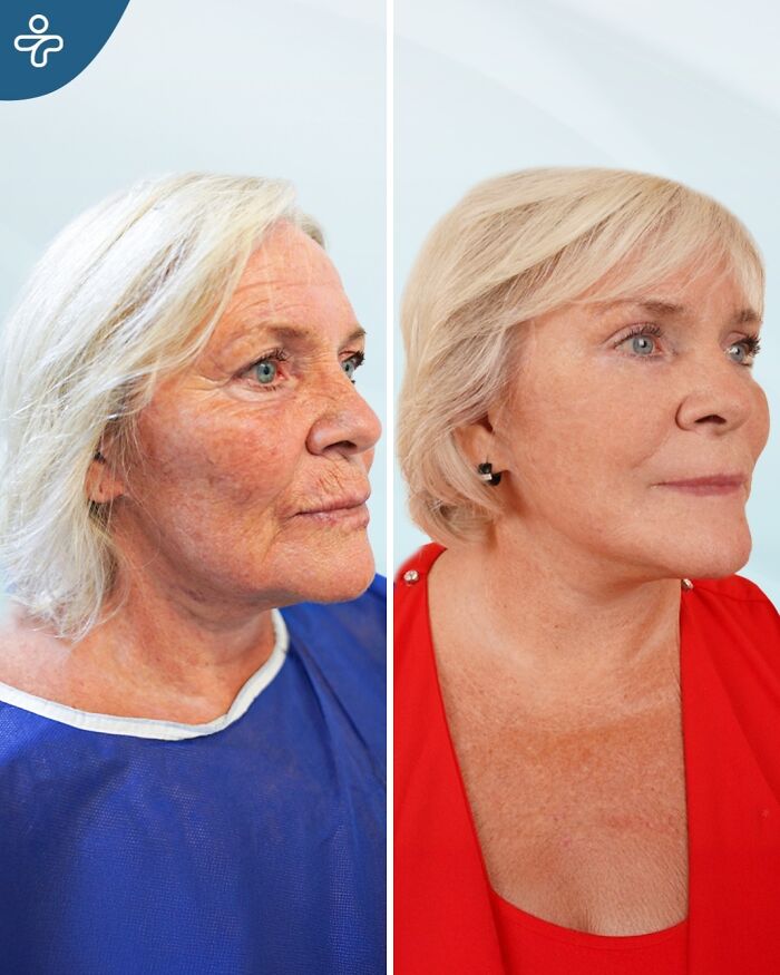 Before and after cosmetic surgery in Turkey showing a woman’s dramatic transformation and improved youthful appearance.