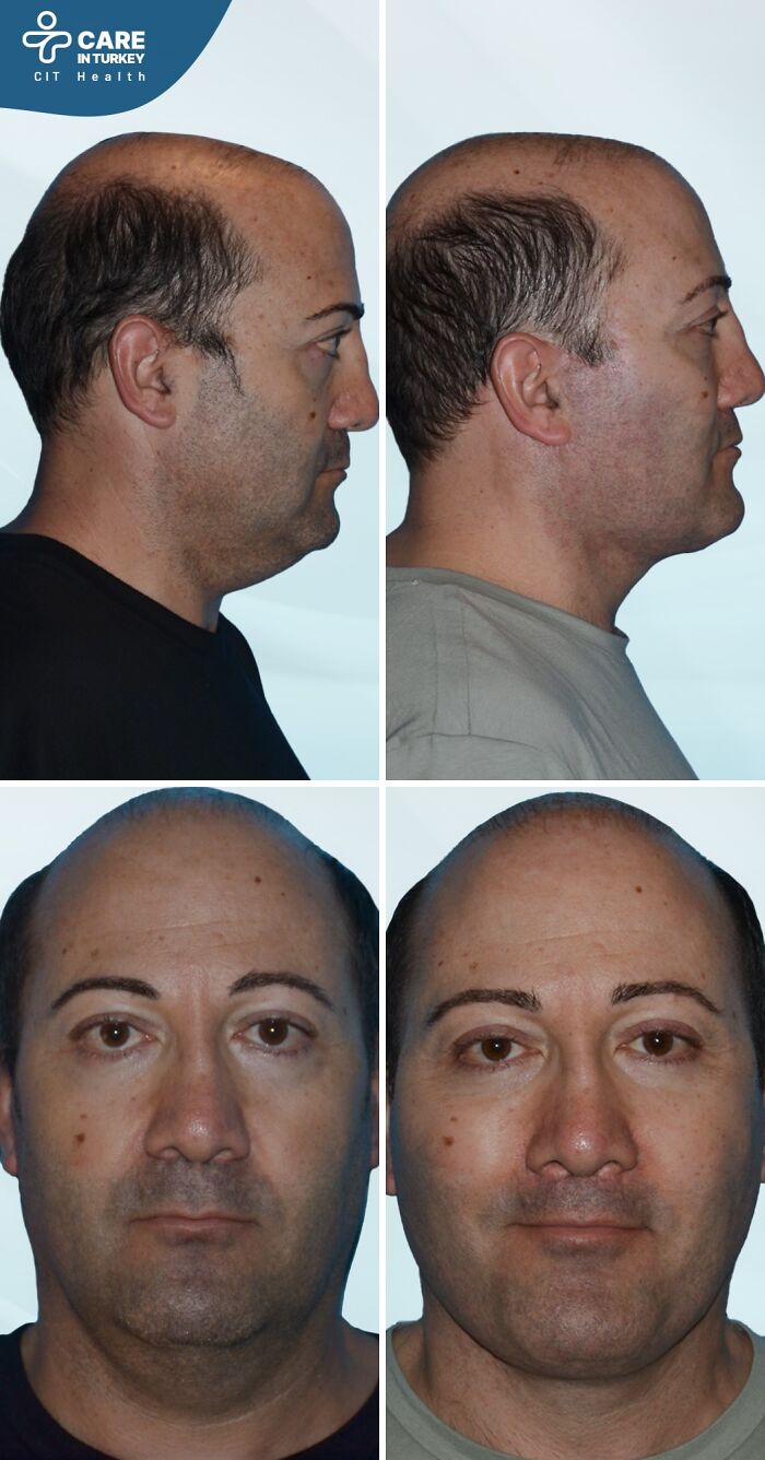 Side and front before and after photos of a man showing changes from cosmetic surgery in Turkey.