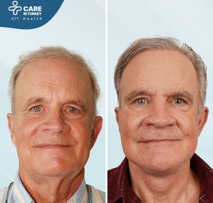 Before and after cosmetic surgery in Turkey showing a man’s facial transformation and rejuvenation results.