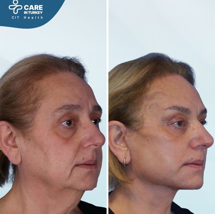 Before and after cosmetic surgery in Turkey showing significant facial transformation and rejuvenation results.