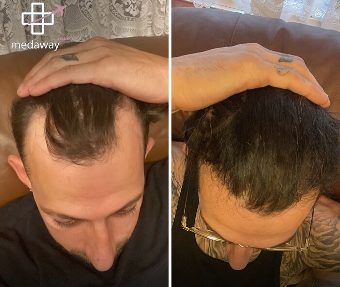 Before and after comparison of hair restoration showing results of cosmetic surgery in Turkey for enhanced hair density.