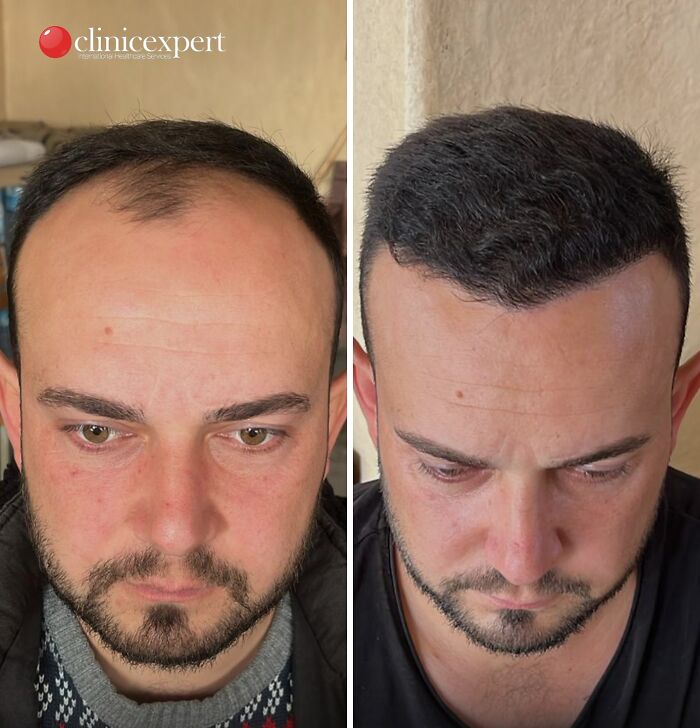 Before and after hair transplant results showing visible improvement, featured in cosmetic surgery in Turkey transformations.