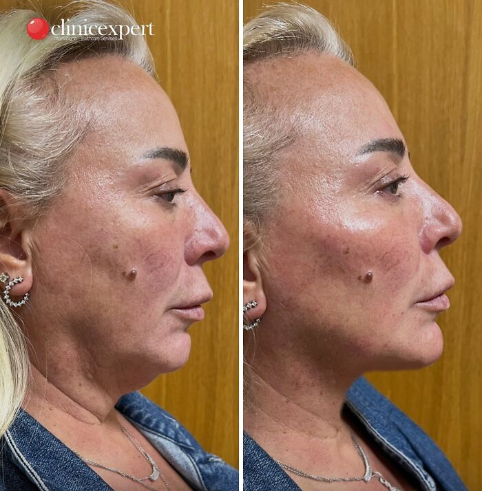Side-by-side before and after photos of a woman showing cosmetic surgery results in Turkey with visible facial enhancements.