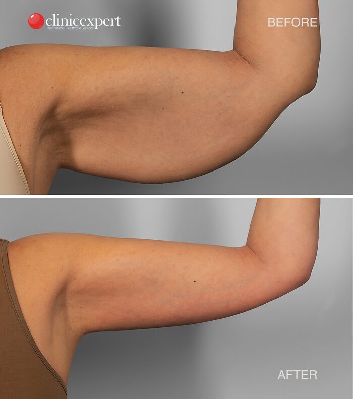 Before and after arm lift cosmetic surgery in Turkey showing reduced sagging and smoother skin texture.