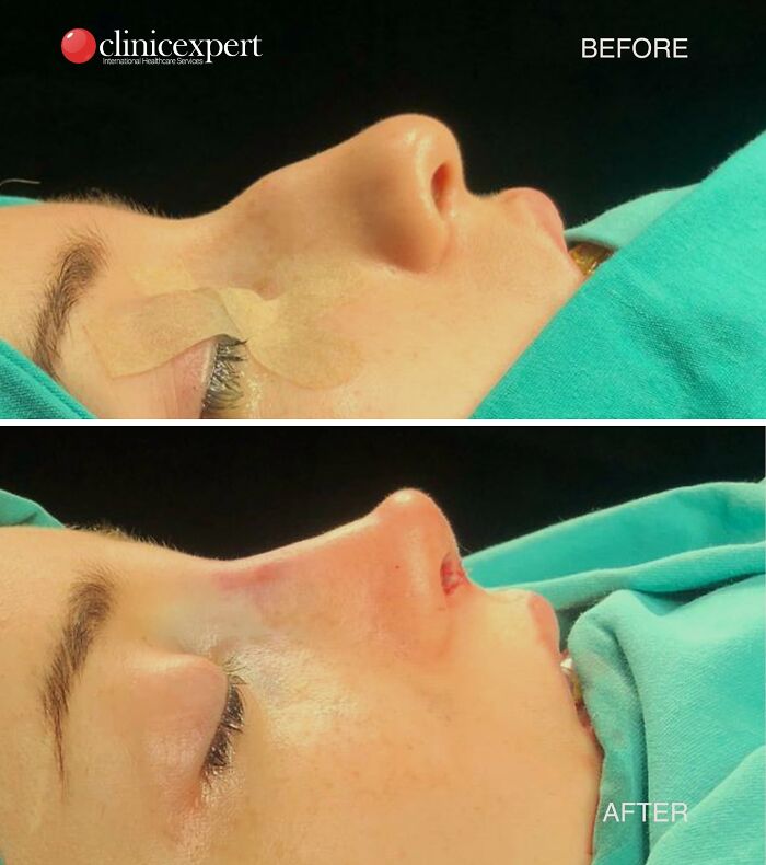 Side-by-side before and after images of a patient’s cosmetic surgery results in Turkey showing facial changes.