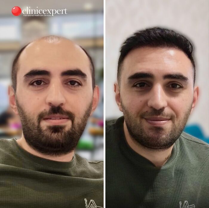 Before and after cosmetic surgery in Turkey showing significant change in appearance of a man with hair restoration.