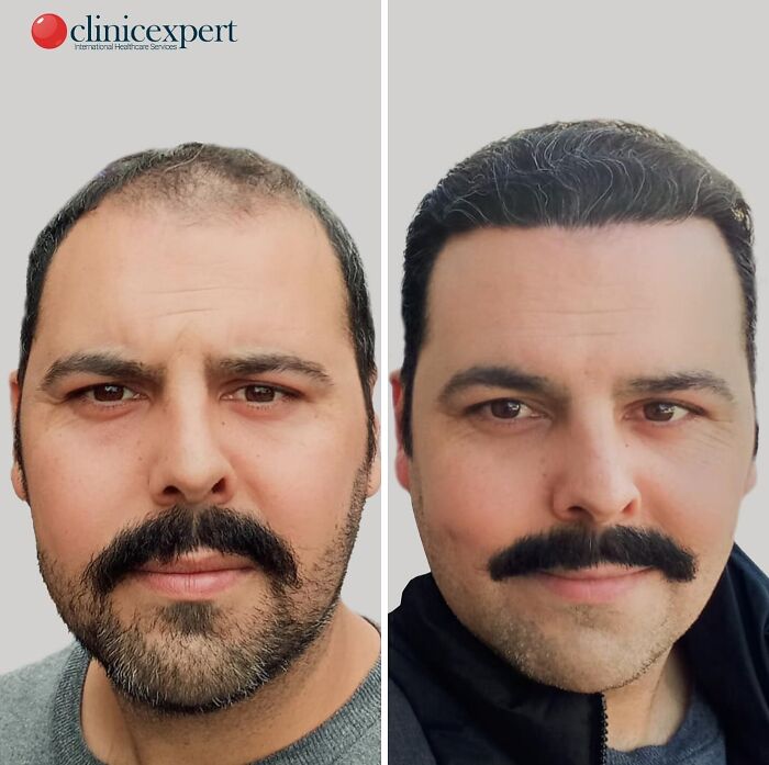 Before and after cosmetic surgery in Turkey showing hair restoration and facial transformation in a man.