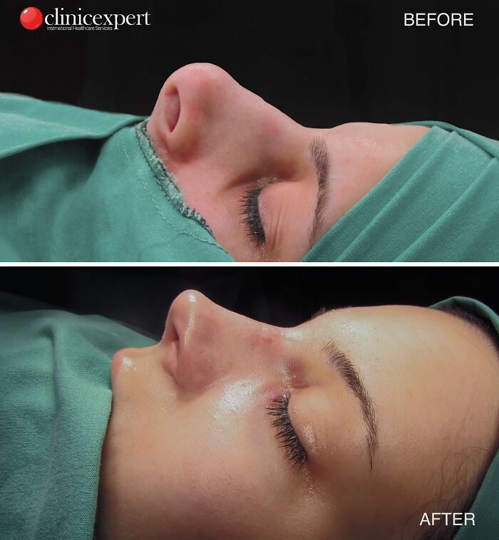 Side-by-side before and after images showing cosmetic surgery results on a woman's nose in Turkey.
