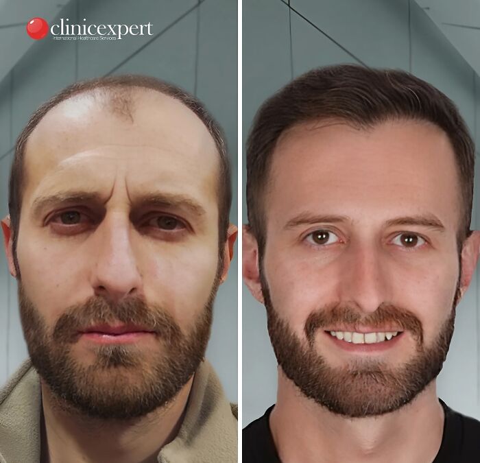 Before and after cosmetic surgery in Turkey showing a man who became completely unrecognizable with a fuller hairline and refreshed appearance.