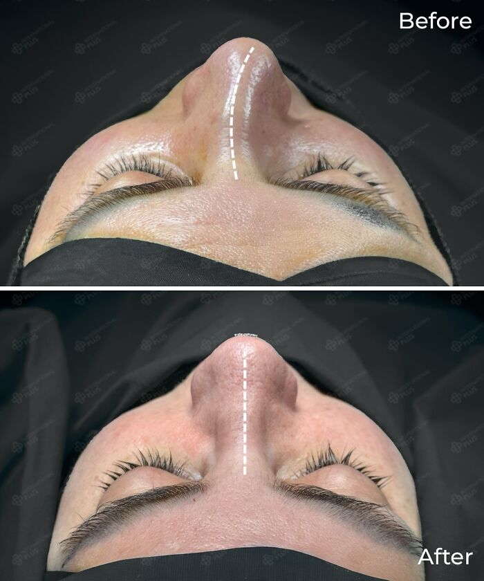 Before and after close-up of a nose showing cosmetic surgery results in Turkey with improved nose shape and alignment.