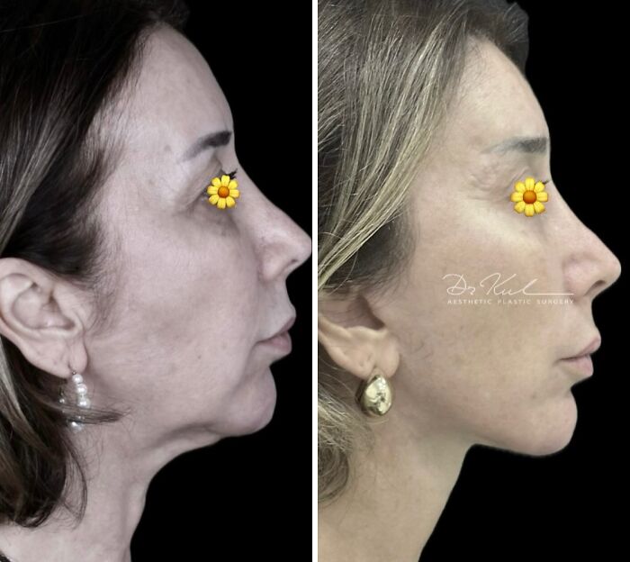 Before and after cosmetic surgery in Turkey showing facial transformation and improved jawline profile on a woman.