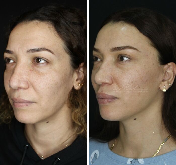 Side-by-side comparison of a woman before and after cosmetic surgery in Turkey showing facial changes and enhancements.