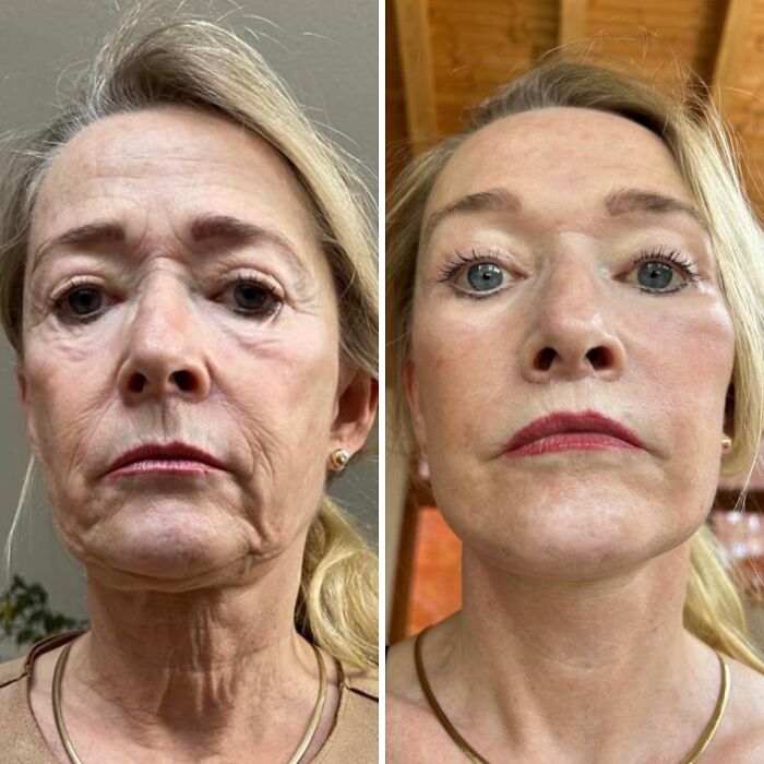 Before and after photos of a woman showing dramatic changes after cosmetic surgery in Turkey, highlighting transformation results.