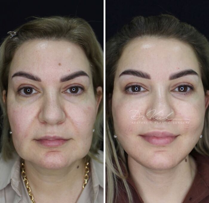 Before and after cosmetic surgery in Turkey showing a woman’s facial transformation and improved skin appearance.