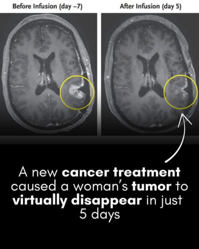 MRI scan comparison showing tumor shrinking after new cancer treatment, illustrating existence and reality of medical progress.