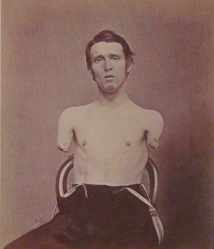 Portrait of a man with amputated arms sitting on a chair, showcasing human strength and diversity in a historical photo.