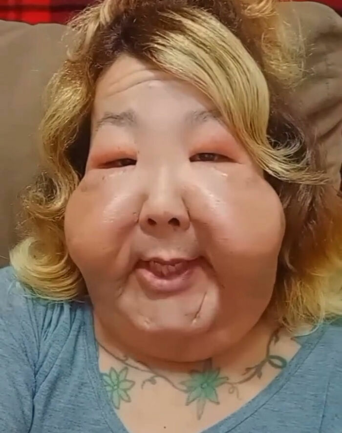 Influencer with swollen face after botched plastic surgery, sharing experience before new operation to restore her look.