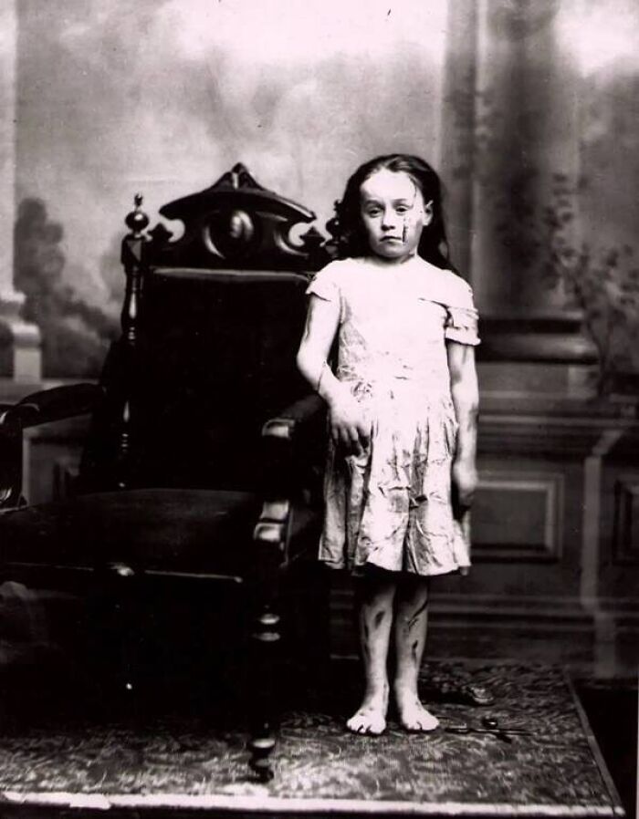 Victorian era weird photo of a barefoot girl with visible marks, standing beside an ornate wooden chair in a vintage room.